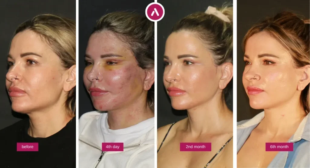Sarah’s deep plane facelift story before and after timeline showing before, day 4 swelling, month 2 refinement, and month 6 results