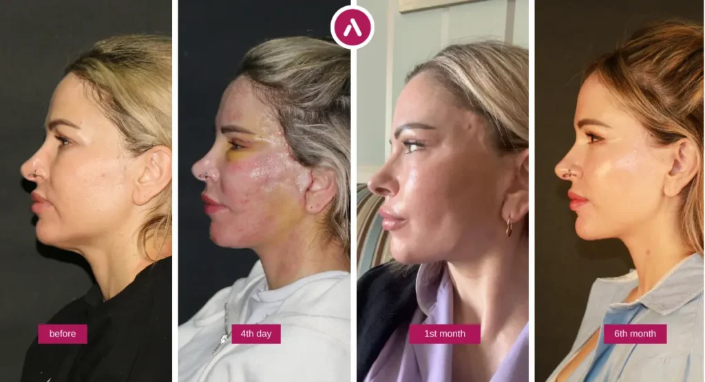 Sarah’s deep plane facelift story recovery timeline showing before, day 4 swelling, month 1 healing progress, and month 6 settled results