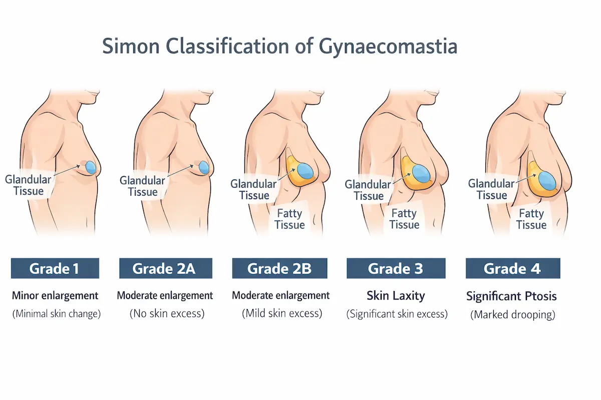 Awake gynaecomastia surgery Simon classification infographic showing Grades 1, 2A, 2B, 3 and 4 with gland vs fat.