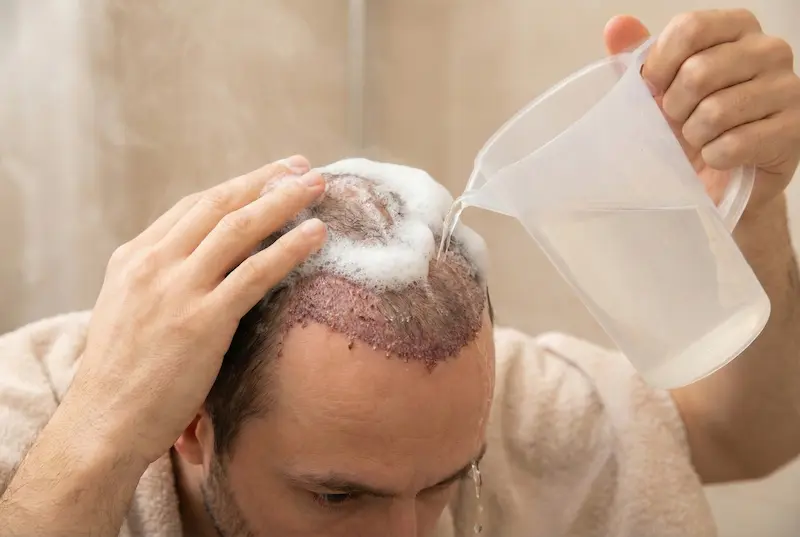Patient performing step-by-step washing hair after transplant using foam shampoo and a gentle cup rinse to protect newly implanted grafts.