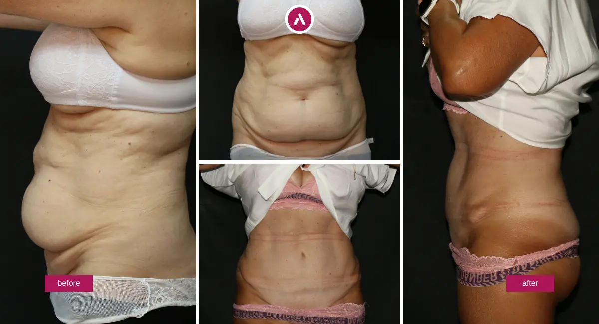 Tummy tuck before and after photo collage showing front and side views with improved abdominal contour and reduced skin laxity; individual results vary.