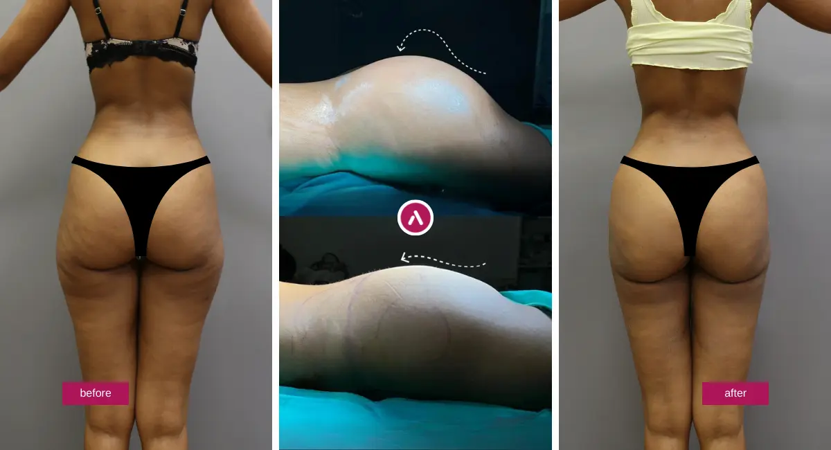 is bbl safe? Ultrasound-guided BBL before and after showing Brazilian butt lift contour change with verified, safer fat transfer.