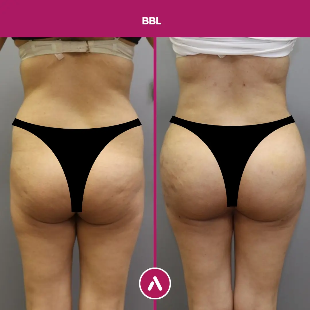BBL Before And After 40 Year Old Patient AKM Clinic Turkey BBL Before And After 40 Year Old Patient AKM Clinic Turkey