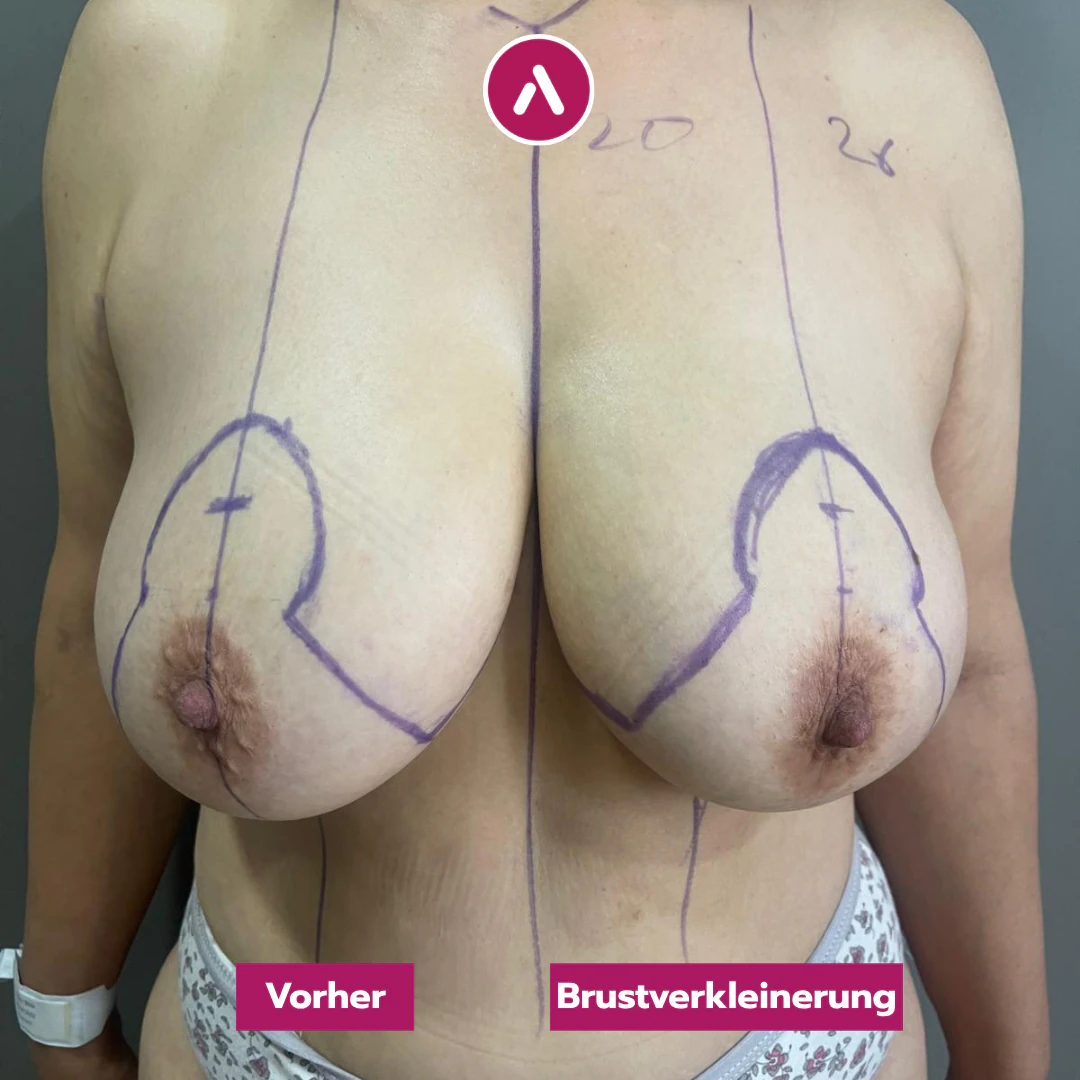Frontal vor der Brustverkleinerung: große, tief hängende Brüste mit präoperativer Anzeichnung, die Unterbrustfalte ist verdeckt