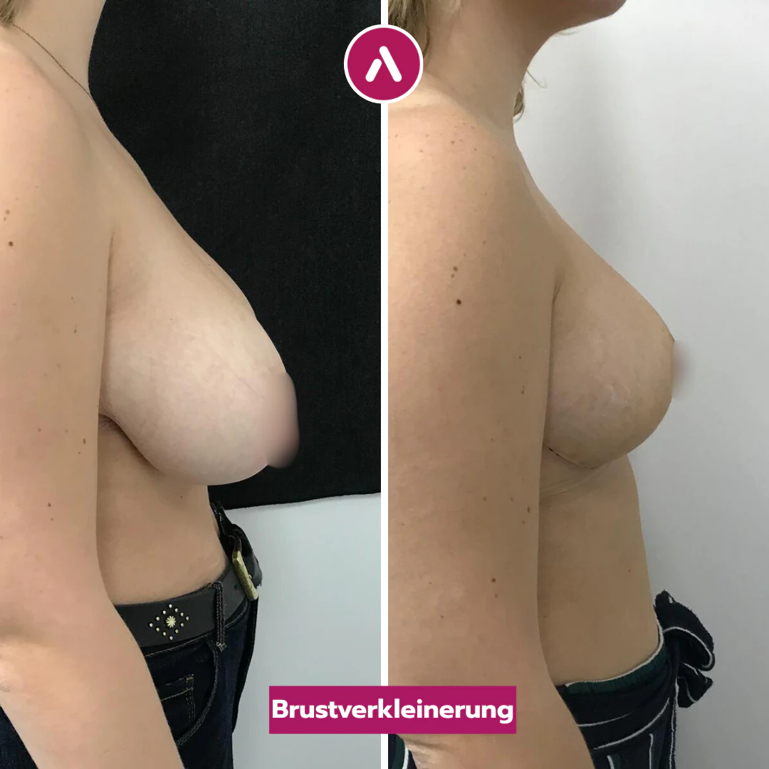 Profil rechts vorher nachher: große, tief stehende Brust (links), nach der Reduktion angehoben und kompakter (rechts)