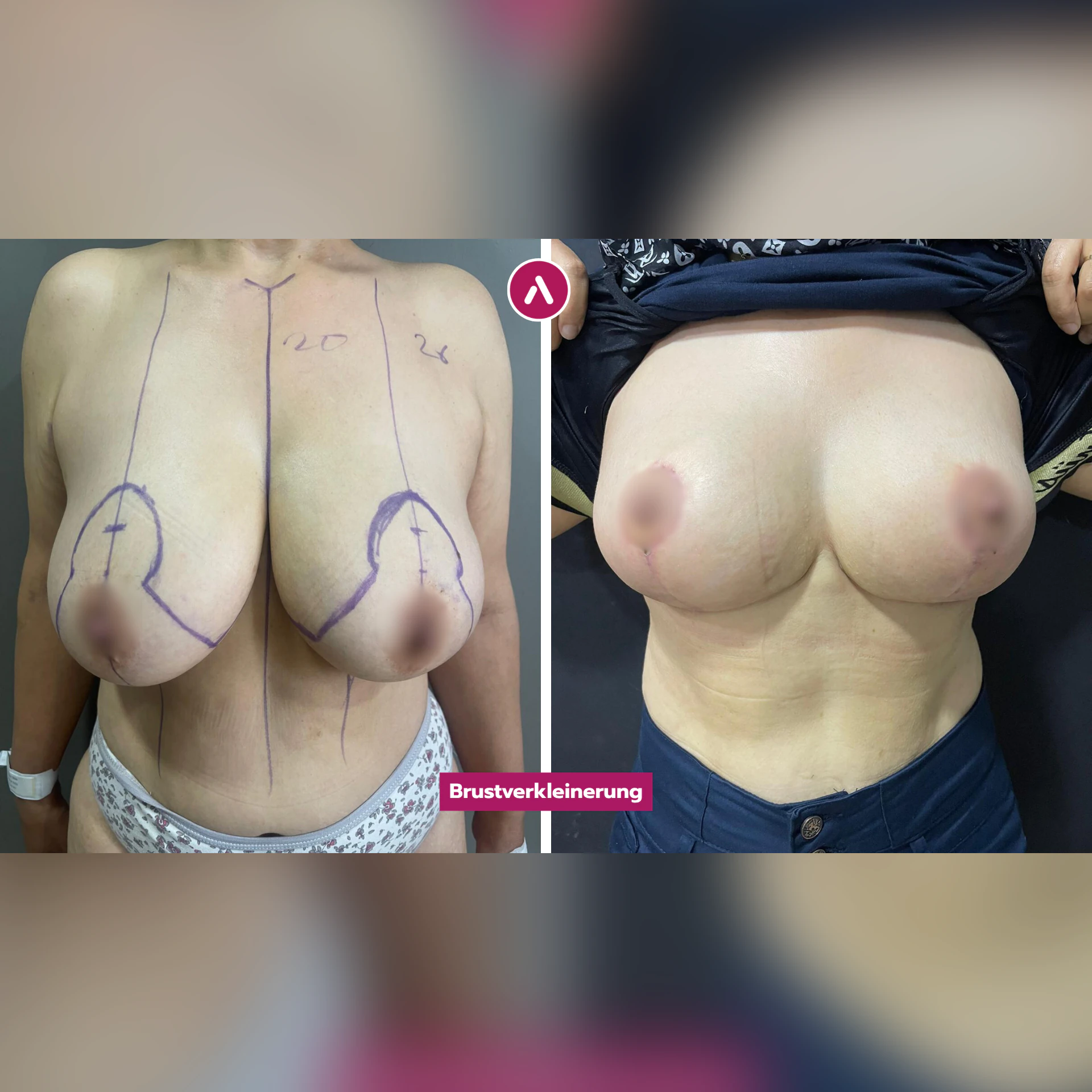 Brustverkleinerung vorher nachher frontal: schwere, hängende Brüste mit Anzeichnung (links), danach kleiner und angehoben (rechts)