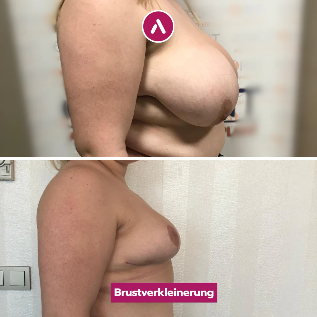 Seitenprofil rechts vor und nach der Brustverkleinerung: schwere, weit vorstehende Brust (oben), danach kompakt und höher (unten)