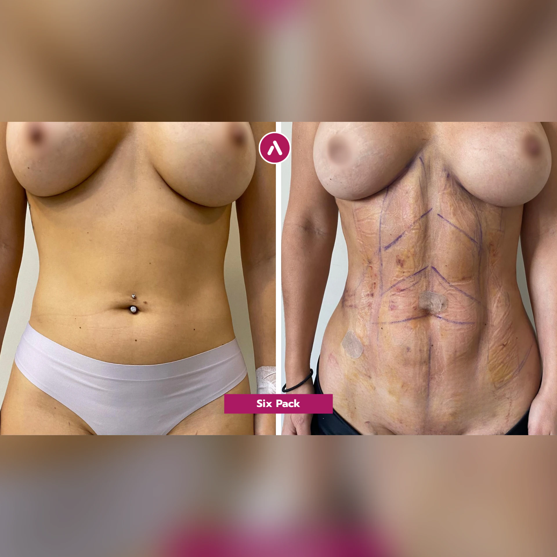 Fettabsaugung Bauch vorher nachher mit Sixpack-OP: weiche Körpermitte (links), kurz nach dem Eingriff schmaler, mit OP-Linien (rechts)