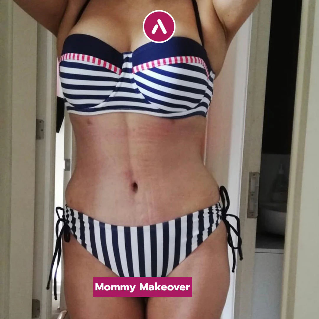 Nach dem Mommy Makeover, frontal im Bikini: flacher Bauch ohne Hautschürze, schmalere Taille, neu geformter Nabel