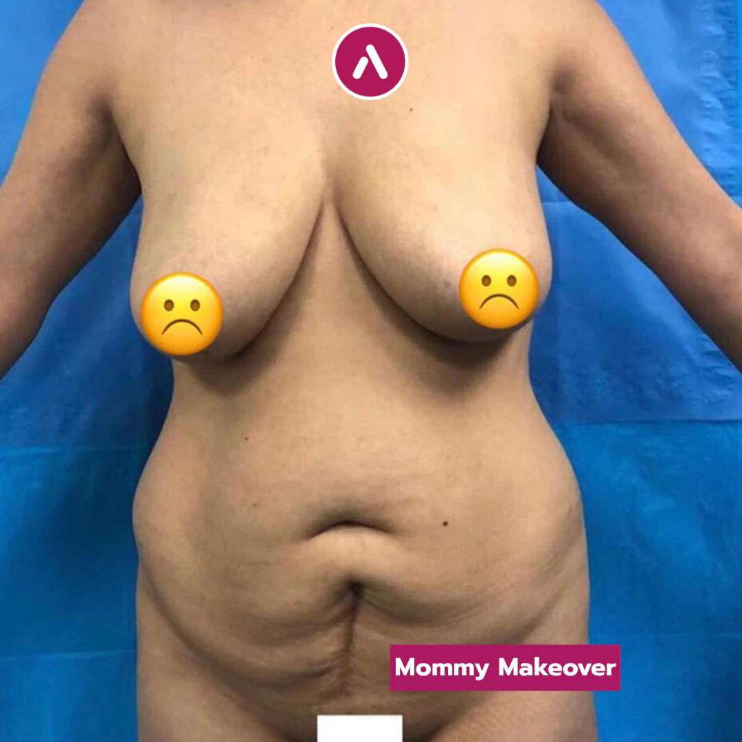 Vor der Hängebauch-OP, frontal: Fettschürze über dem Unterbauch, tiefe Querfalte am Nabel, tief hängende Brüste