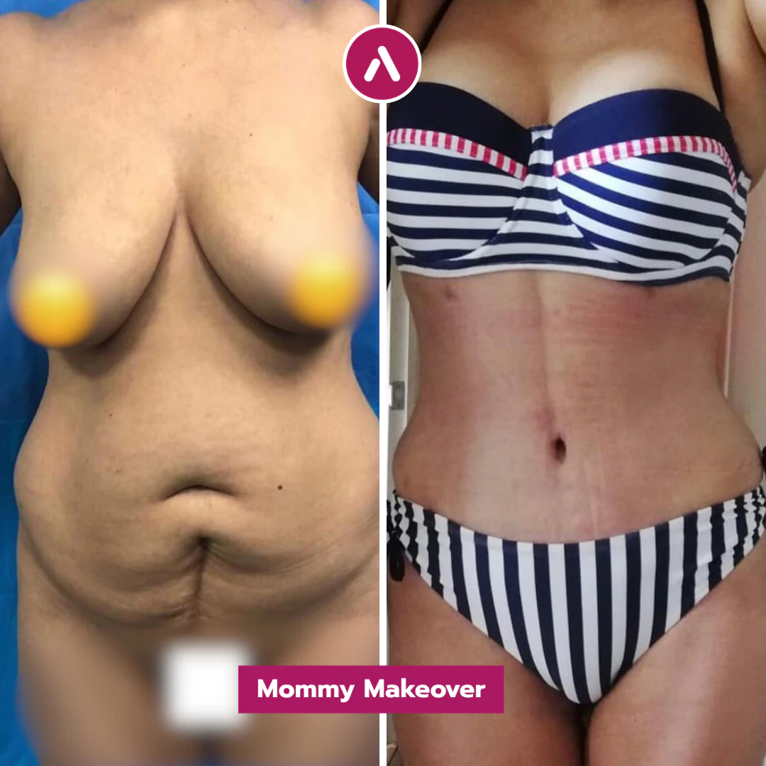 Hängebauch-OP vorher nachher, Mommy Makeover: Fettschürze und hängende Brust (links), im Bikini flacher Bauch mit Taille (rechts)