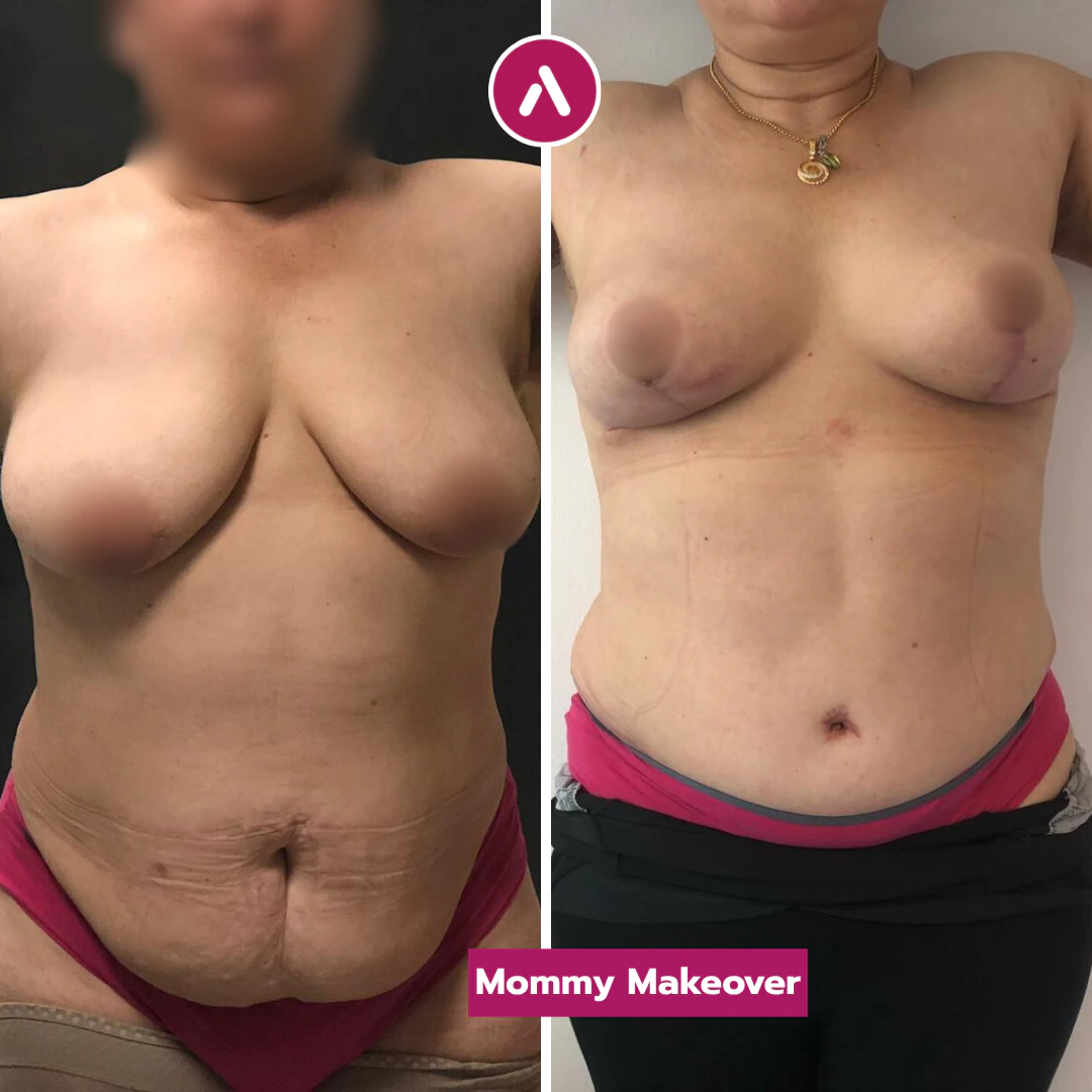 Mommy Makeover vorher nachher: hängende Bauchhaut und Brust (links), danach flacher Bauch, neuer Nabel, höhere Brust (rechts)