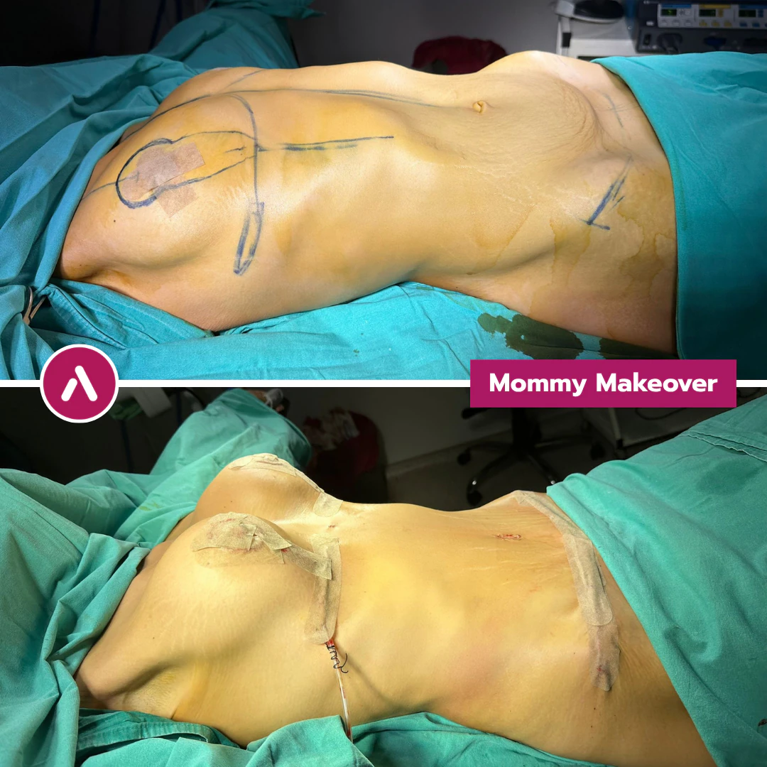 Mommy Makeover vorher nachher, OP-Tisch: angezeichnete Brust und Bauch (oben), direkt danach Brust voller, Bauch flacher (unten)