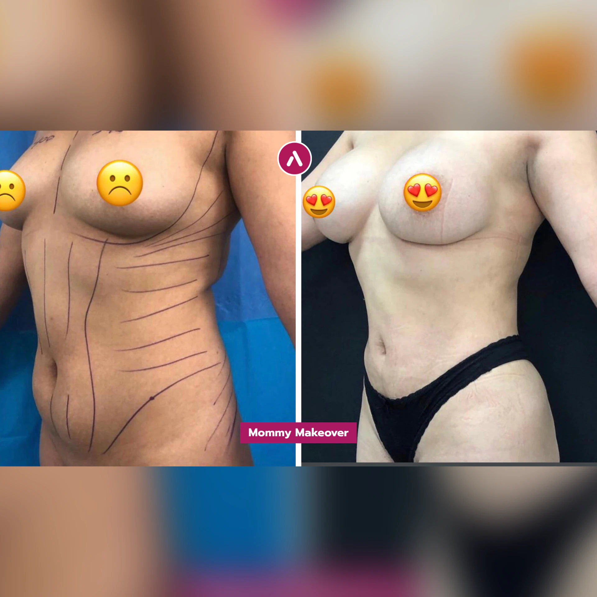 Mommy Makeover vorher nachher, schräg links: angezeichnete Brust und Bauch (links), danach straffe Brust, flacher Bauch (rechts)