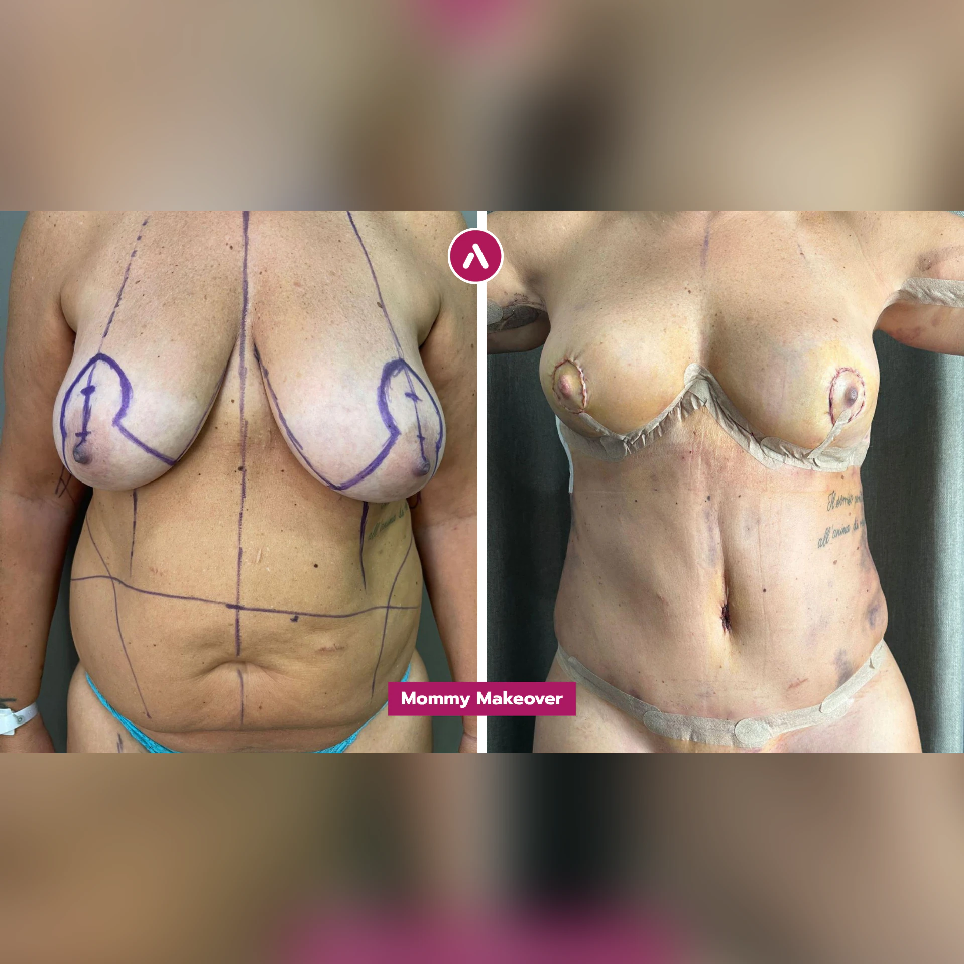 Mommy Makeover vorher nachher mit 50: abgesunkene Brust, weicher Bauch (links), kurz danach gestrafft, mit Nähten (rechts)