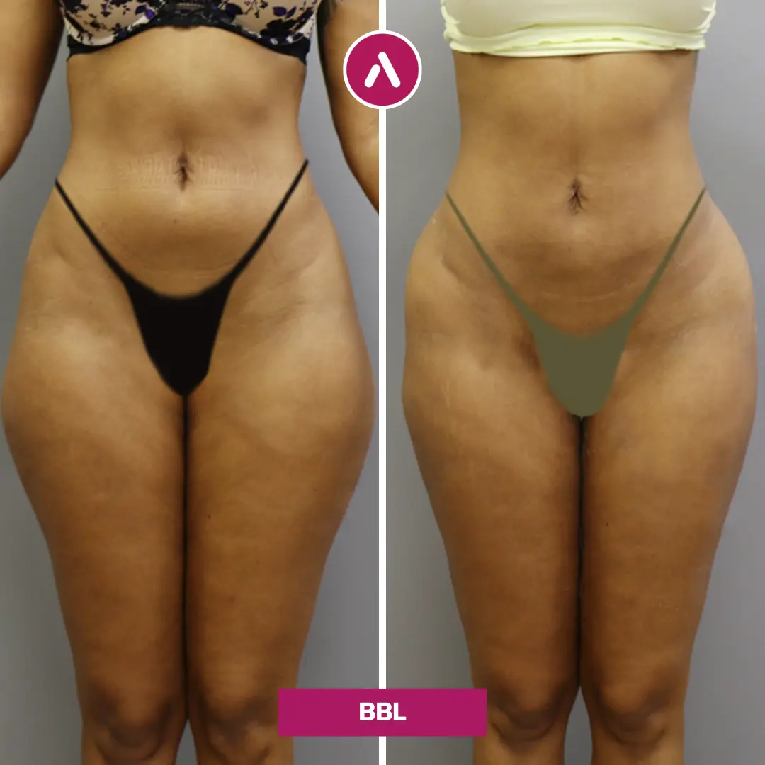 BBL Before And After 35 Year Old Patient AKM Clinic Turkey BBL Before And After 35 Year Old Patient AKM Clinic Turkey