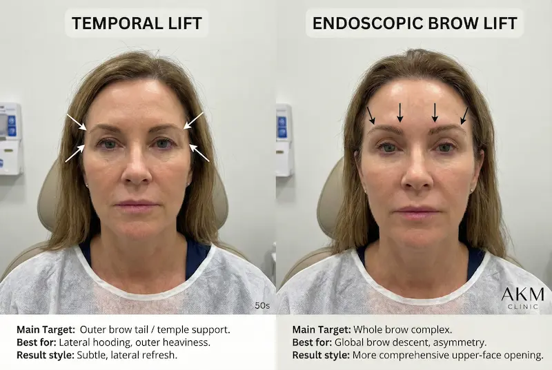 Temporal lift vs brow lift side-by-side comparison image showing temporal lift targeting the outer brow tail/temple support and endoscopic brow lift targeting the whole brow complex.