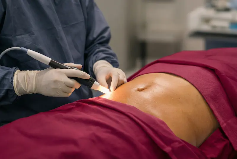 what is j-plasma (renuvion) skin tightening: liposuction sonrası karın bölgesinde subdermal cilt sıkılaştırma uygulamasının klinik ortamda gerçekleştirilmesi