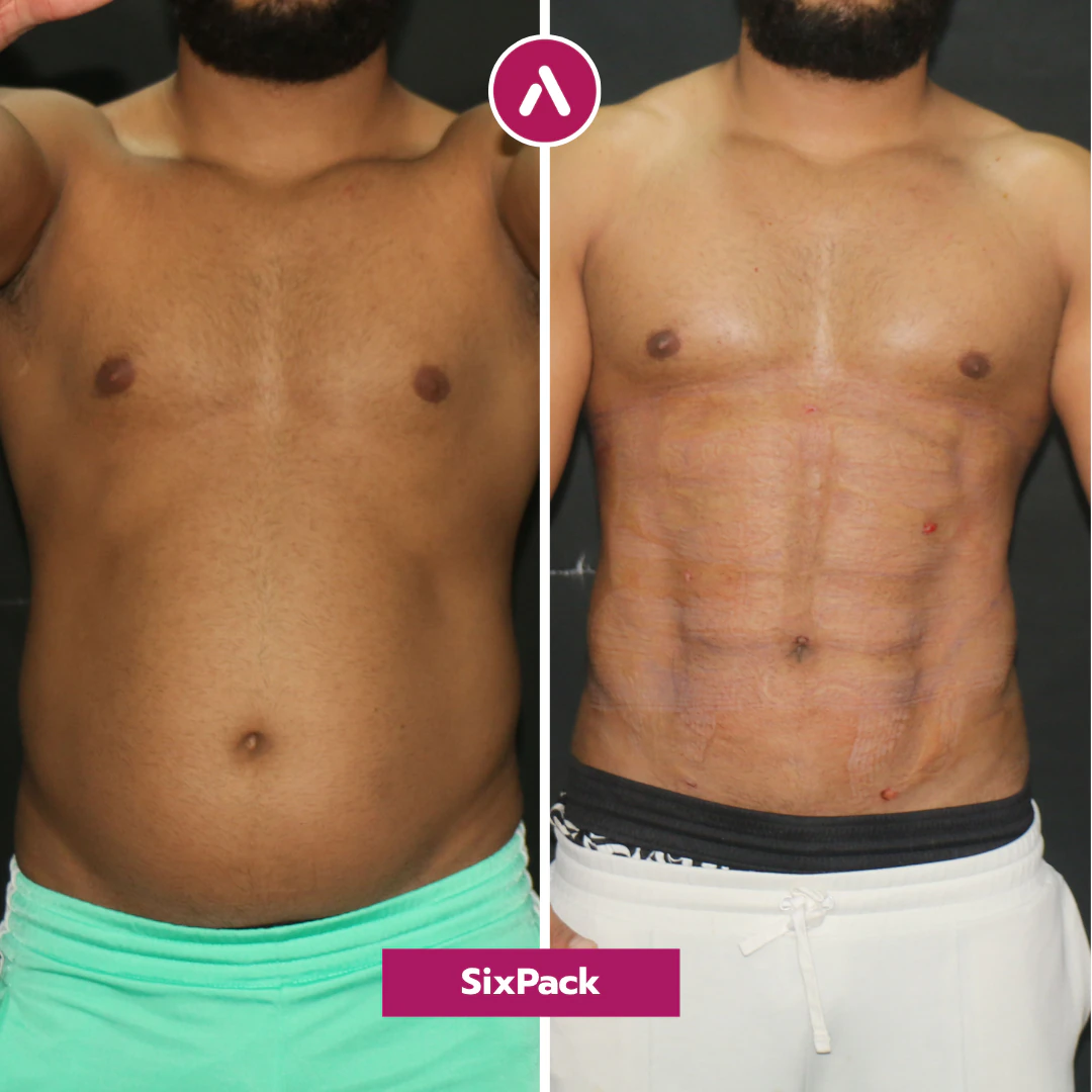 Frontal vorher nachher: runder Bauch eines 33-Jährigen (links), kurz nach der Sixpack-OP mit ausgeprägter Muskelzeichnung (rechts)