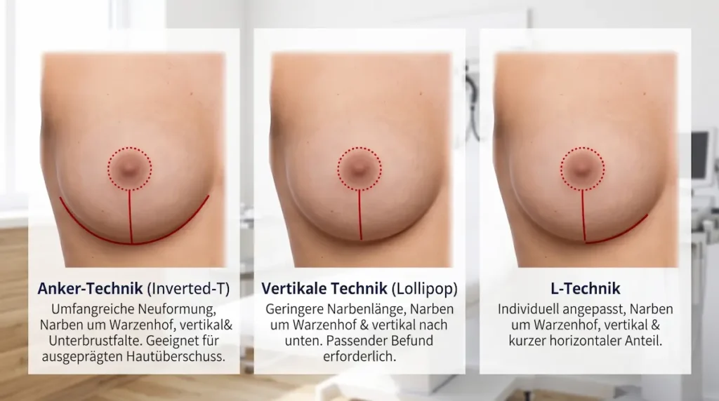 Brustverkleinerung Erfahrungen: Vergleich von Anker-, Lollipop- und L-Technik mit schematisch dargestellten Narbenverläufen.