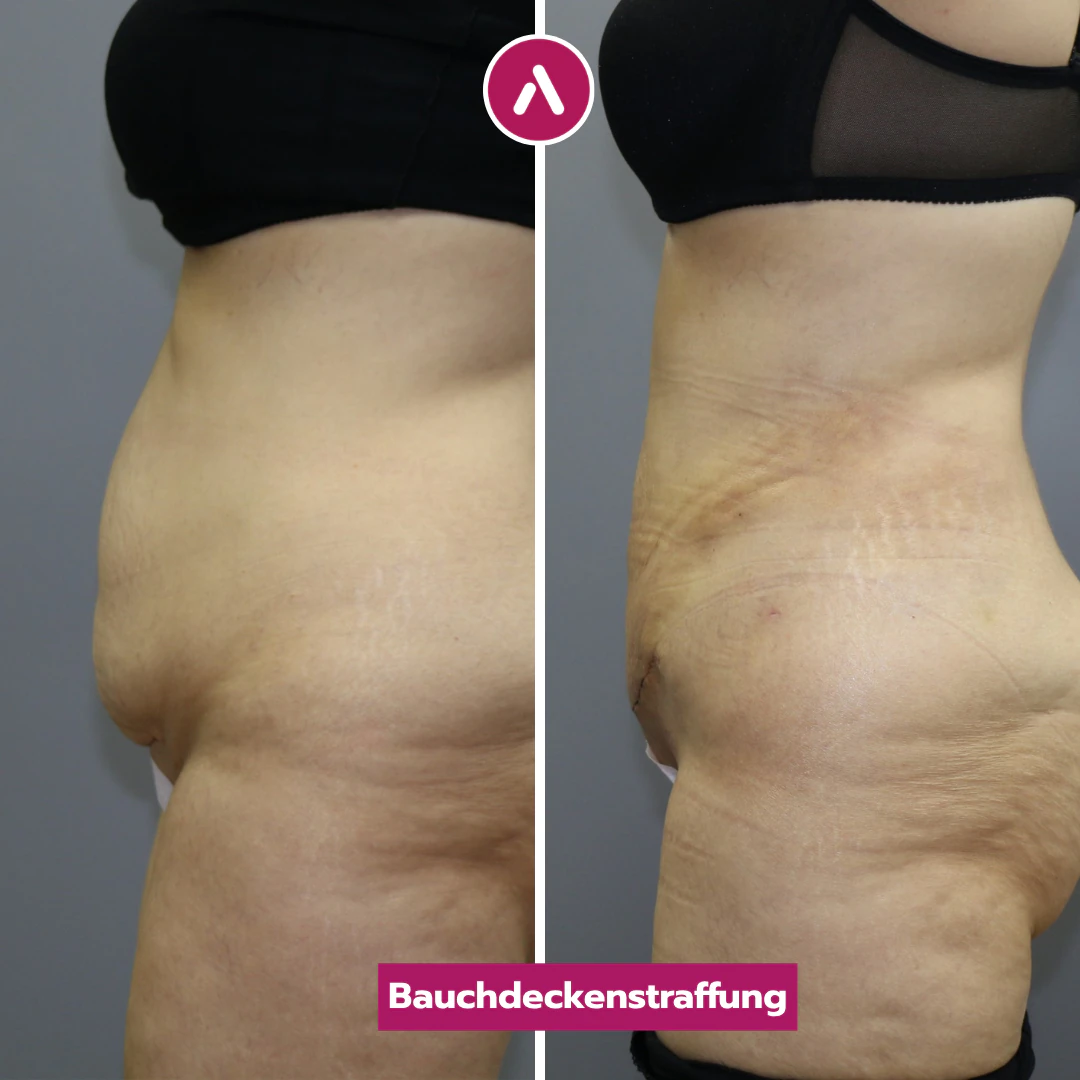 Profil vorher nachher: vorgewölbter Unterbauch (links), nach der Bauchdeckenstraffung flachere Kontur mit frischer Naht (rechts)