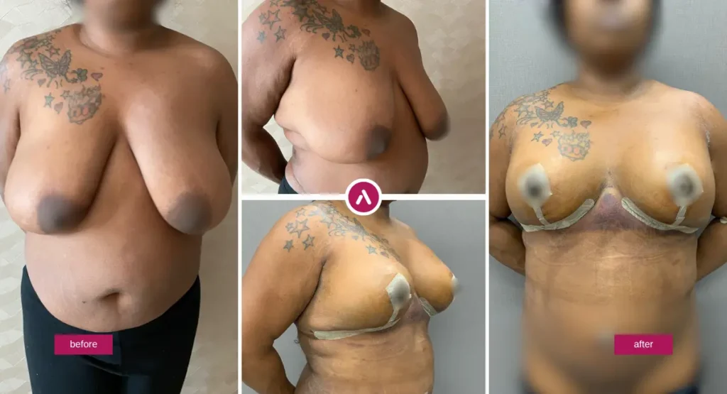 Breast Reduction Before and After Black Women collage showing front and side views with improved lift, contour, and healing incisions.