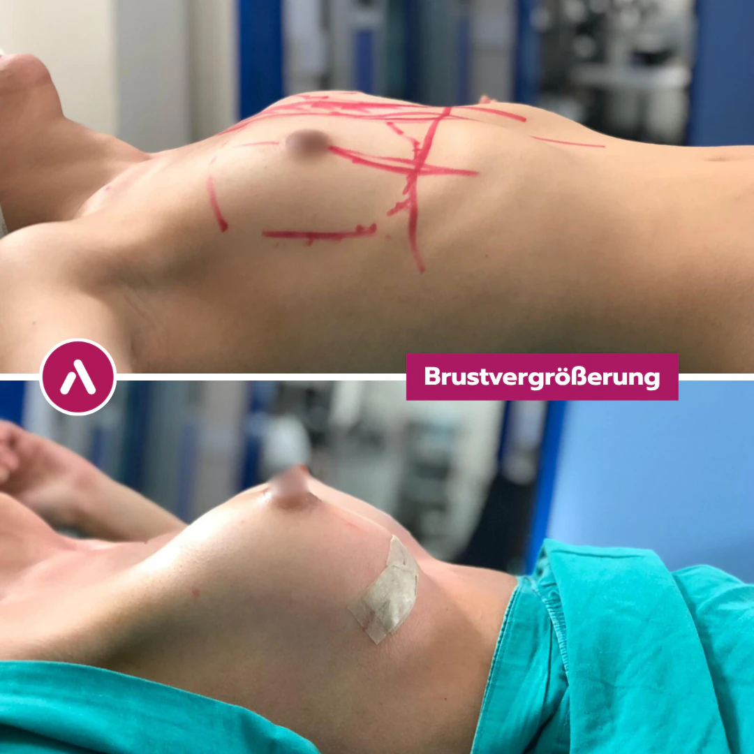 Profil rechts: Brust vor der Brustvergrößerung mit Planungslinien (oben), direkt nach dem Einsetzen der Implantate (unten)