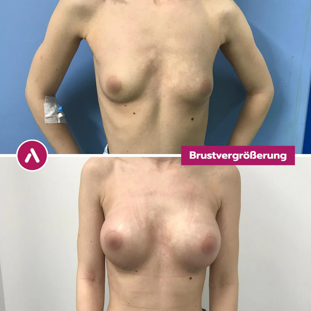 Frontal vorher nachher: ungleich große Brüste (oben), nach der Brustvergrößerung mit zwei Implantatvolumina angeglichen (unten)