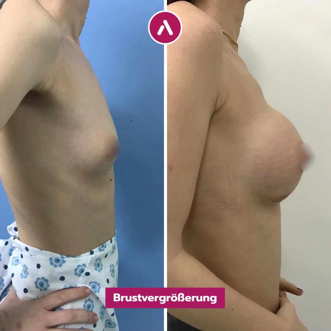 Profil rechts vorher nachher: kleine, flache Brust (links), nach der Brustvergrößerung mehr Volumen und Projektion (rechts)