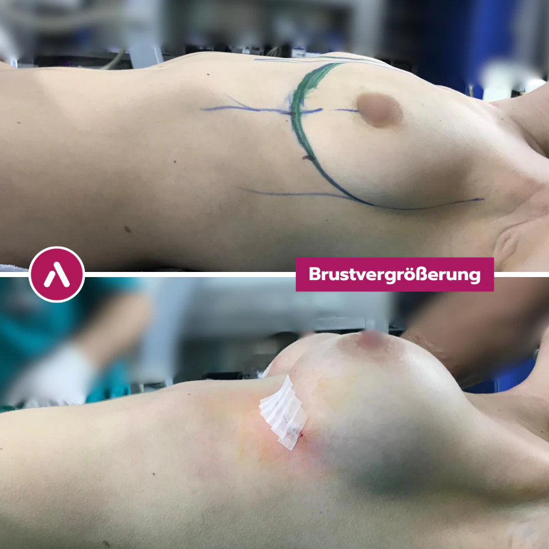 Profil links im Liegen: Brust mit OP-Markierungen (oben), direkt nach der Brustvergrößerung mit Pflastern und Verfärbungen (unten)