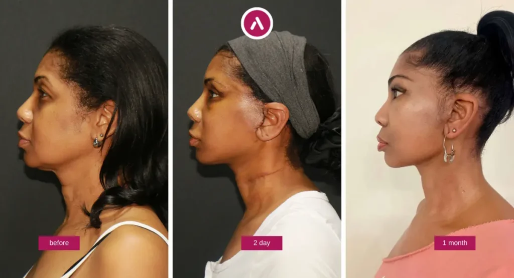 Deep Plane Facelift Recovery Day By Day Photo showing a real timeline with side-profile images: before surgery, day 2 swelling phase, and 1 month healing progress.