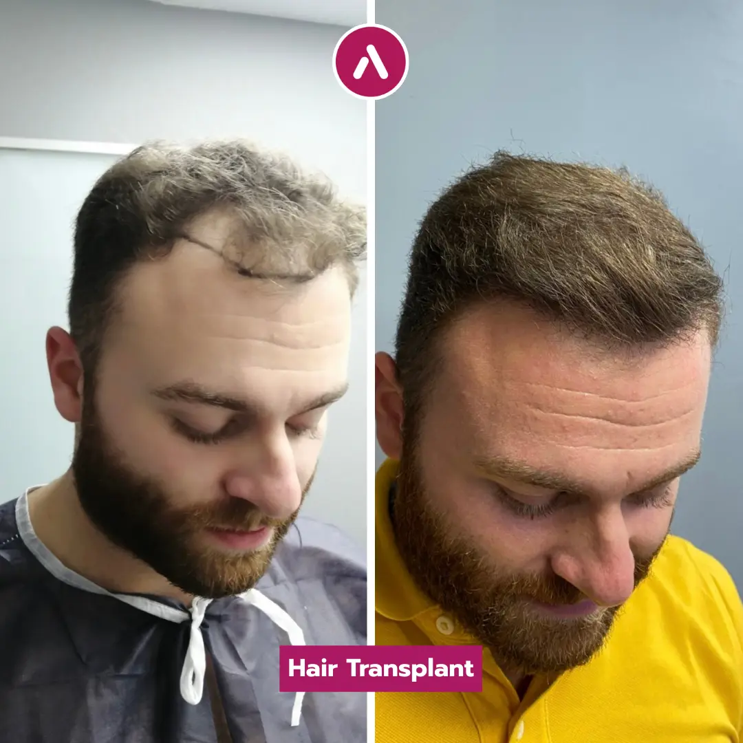 FUE Hair Transplant Before And After 35yo US Patient Result