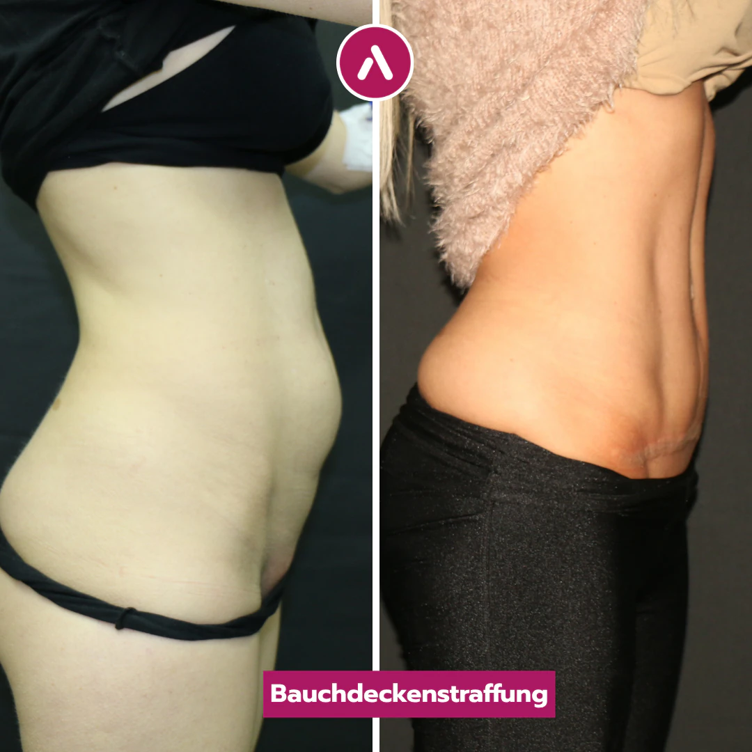Seitenansicht vor und nach Bauchdeckenstraffung & Sixpack-OP: runde Unterbauchwölbung (links), schlanke Taille (rechts)