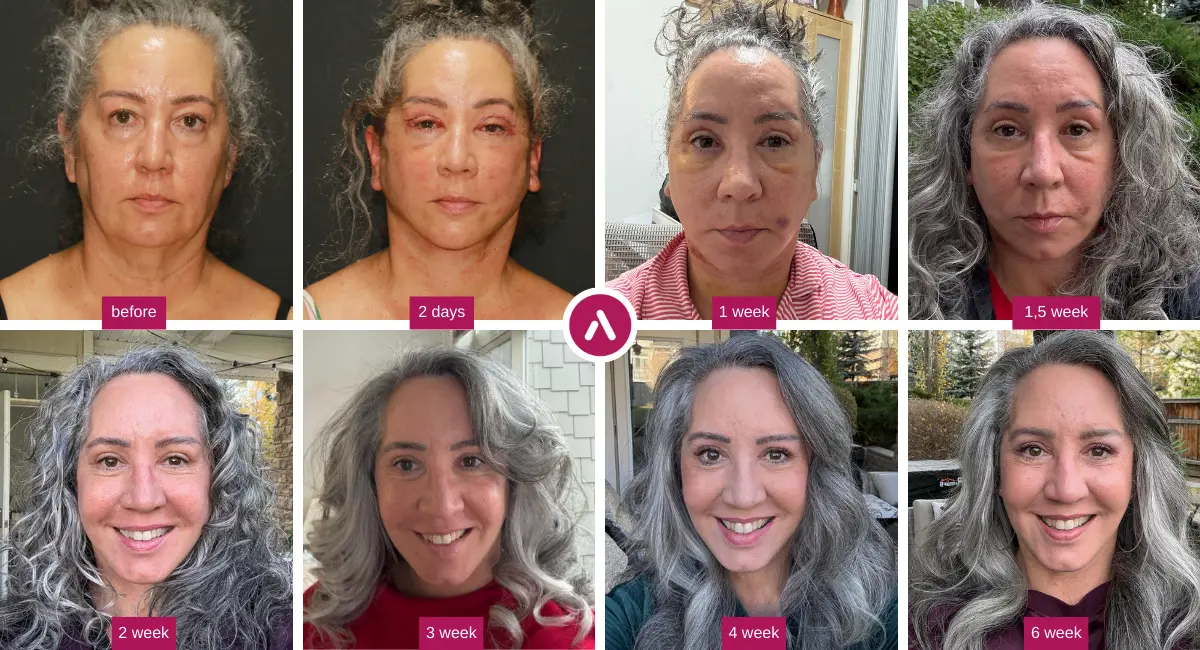 Facelift recovery timeline collage of a USA patient showing before, 2 days, 1 week, 2 weeks, 3 weeks, 4 weeks, and 6 weeks results