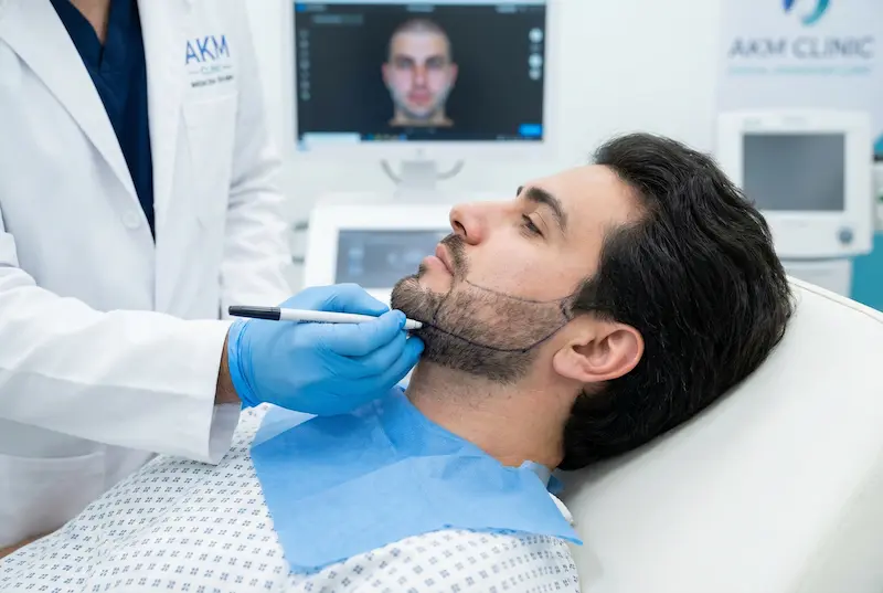 Doctor marks a jawline beard design during a consultation, showing how beard shape can change the jawline definition before a beard transplant.