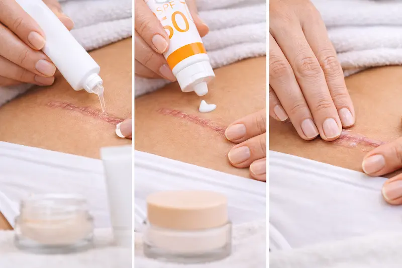 At-home tummy tuck scar treatment steps showing silicone gel application, SPF sunscreen use, and gentle scar massage on a healing lower abdominal incision.