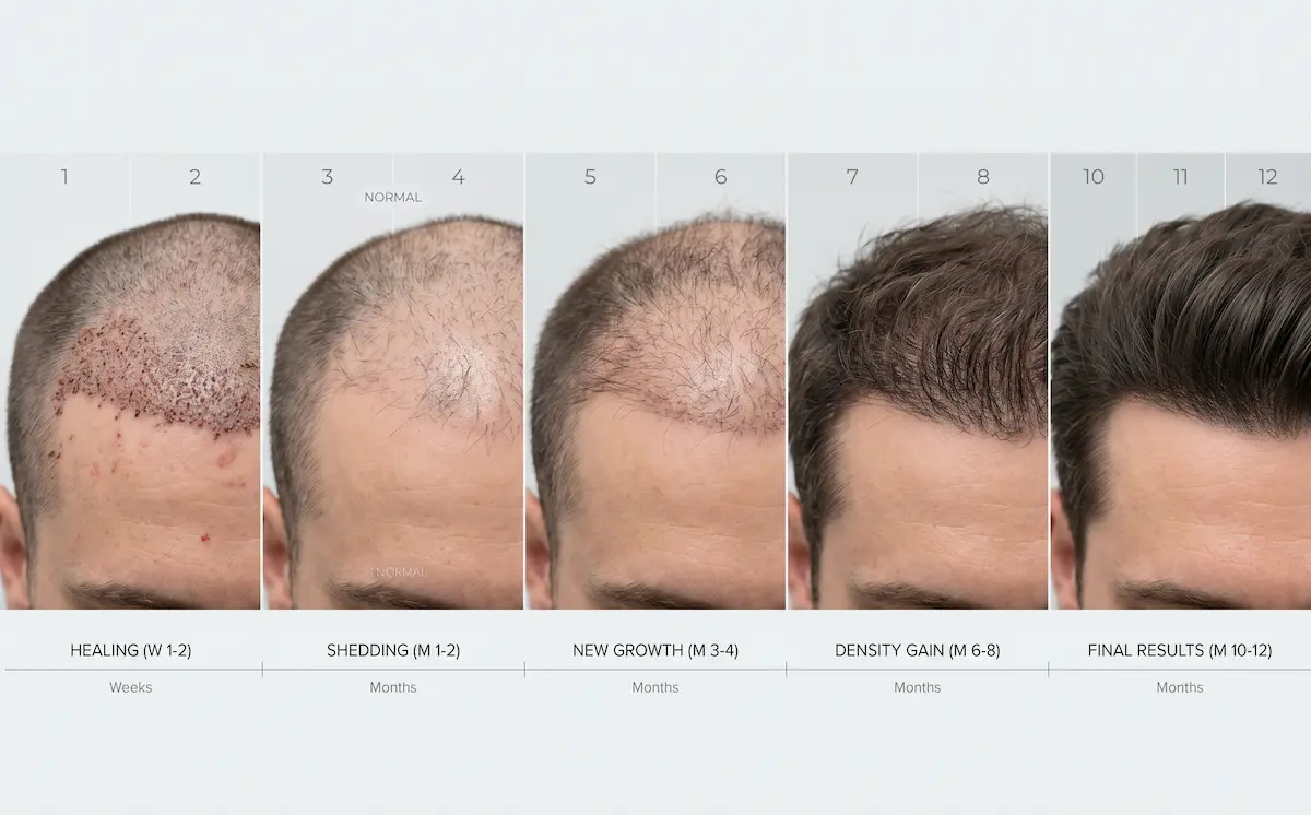 Realistic 5-stage visual timeline showing hair transplant recovery from week 1 to month 12, detailing initial healing, shock shedding, new growth, density gain, and final results.