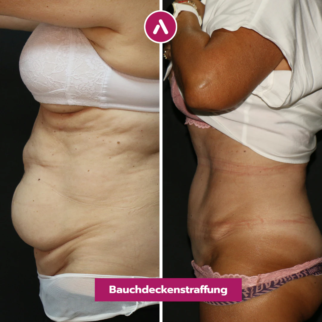 Profil links vorher nachher: überhängende Bauchfalte über dem Slip (links), nach der Bauchdeckenstraffung flacher Bauch (rechts)