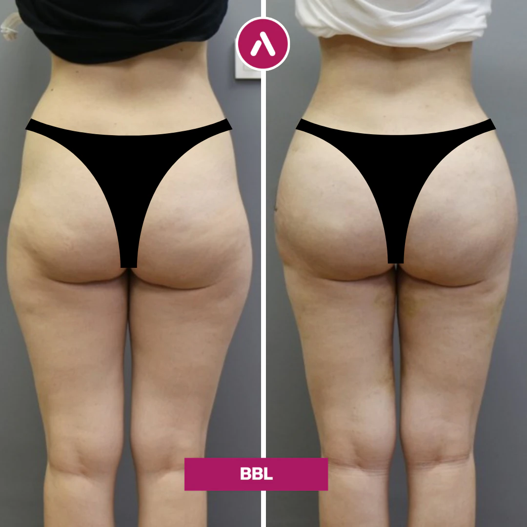 BBL vorher nachher, Rückansicht: flache Gesäßpartie mit Hip Dips (links), rundere Kurve und aufgefüllte Hüften (rechts)