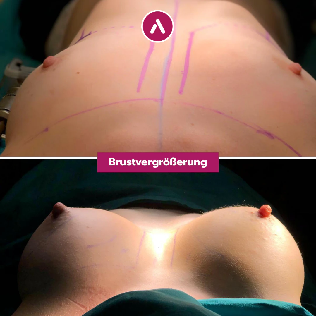 Von unten gesehen, in Rückenlage: kleine Brüste mit violetten Linien (oben), nach der Brustvergrößerung deutlich voller (unten)