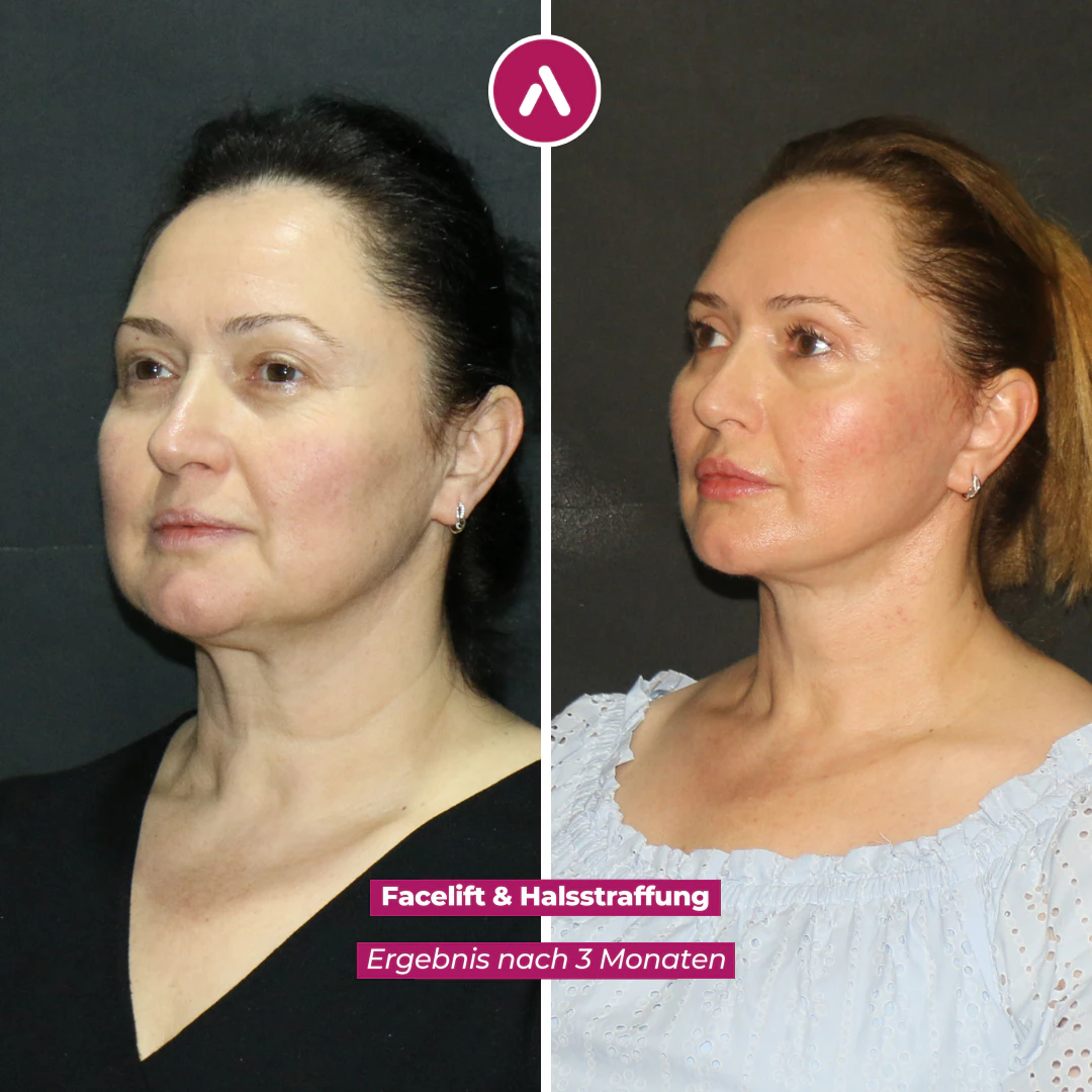 Deep-Plane-Facelift schräg links: Kieferlinie unter Hängebäckchen (links), nach drei Monaten scharf gezeichnet (rechts)