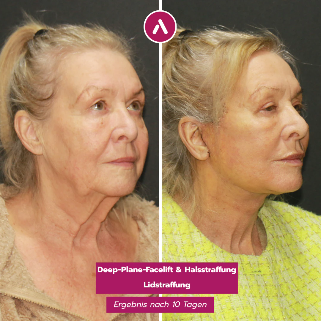 Schräg rechts vorher nachher: schlaffe Wange und Hals (links), zehn Tage nach Deep-Plane-Facelift gestrafft (rechts)