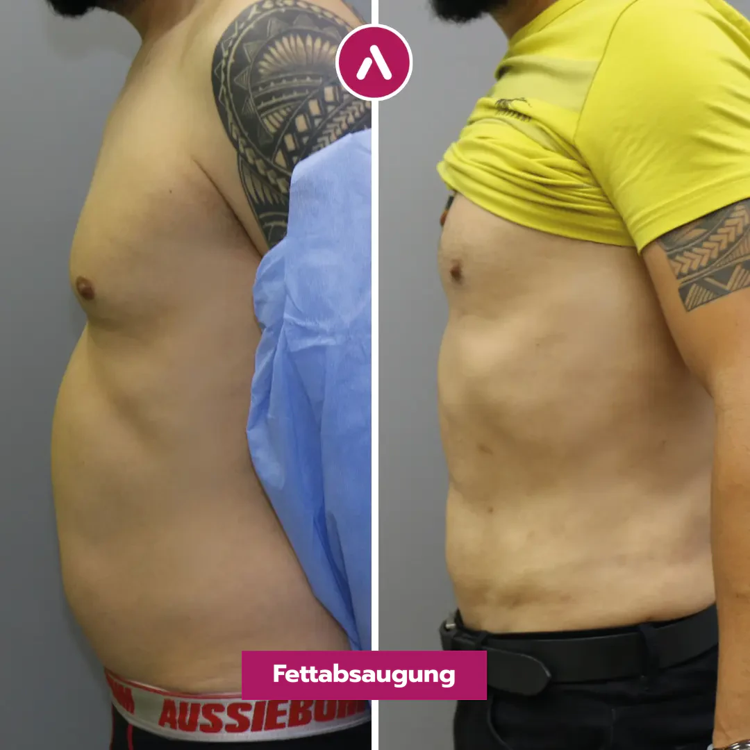 Linkes Profil vorher nachher: runder Bauch über dem Bund (links), flache, athletische Körpermitte nach der Fettabsaugung (rechts)