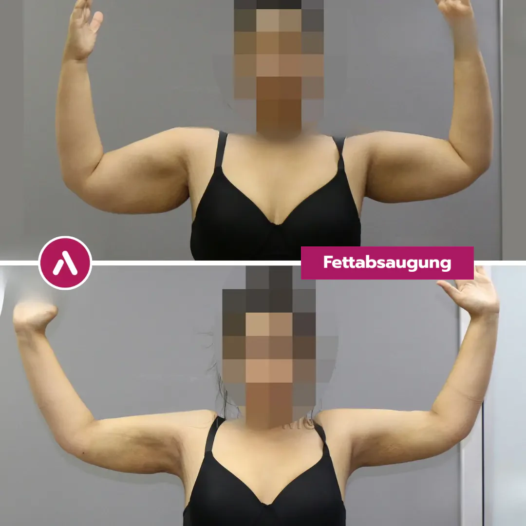 Frontal mit erhobenen Unterarmen: Fettpolster an den Innenseiten der Oberarme (oben), nach der Absaugung schlankere Arme (unten)