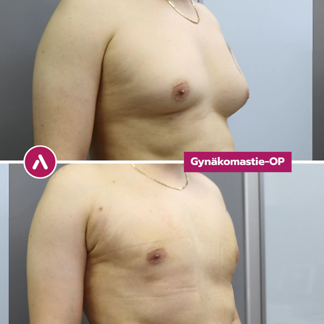Gynäkomastie-OP vorher nachher, schräg rechts: vorgewölbte Brust (oben), eine Woche nach dem Eingriff flach (unten)