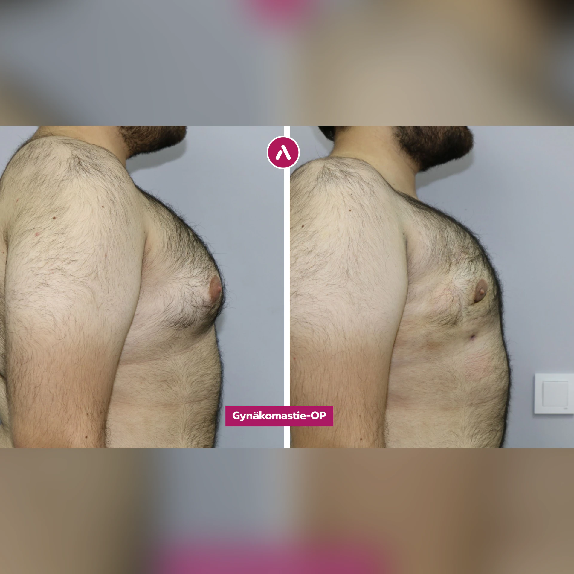 Gynäkomastie-OP vorher nachher, rechtes Profil: vorstehende Brust mit rosigem Warzenhof (links), flache Brustwand (rechts)