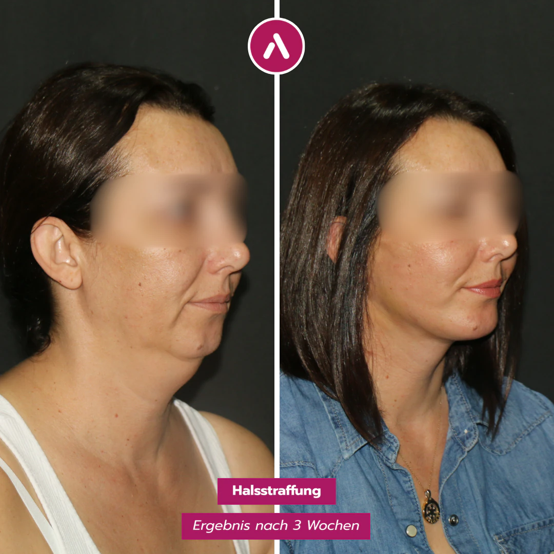 Schräg rechts vorher nachher: Fülle unter Kinn und Kiefer (links), drei Wochen nach der Halsstraffung schlanker Hals (rechts)