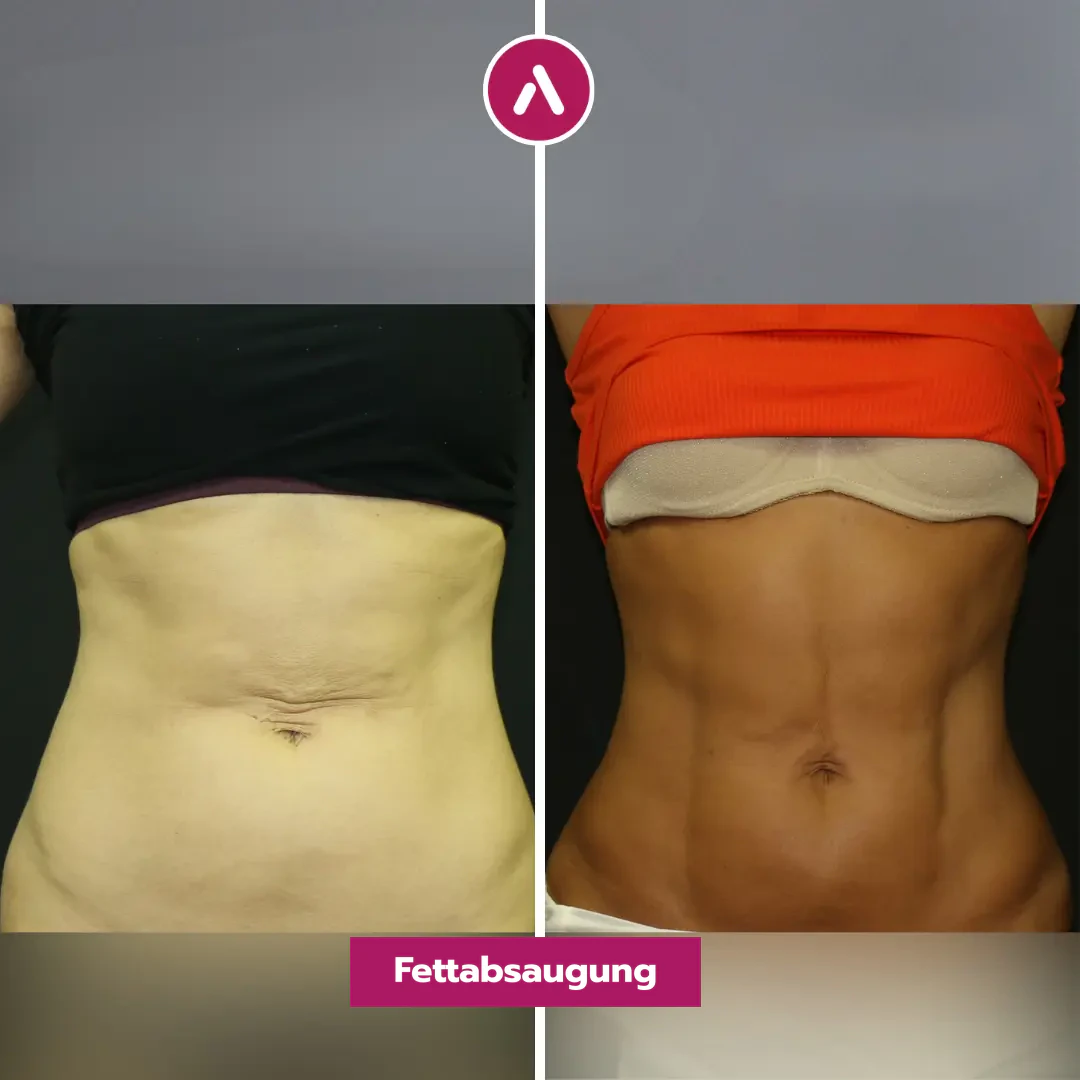 Bauch von vorn vorher nachher: weicher Unterbauch ohne Kontur (links), sichtbare Bauchmuskeln nach der HD-Fettabsaugung (rechts)