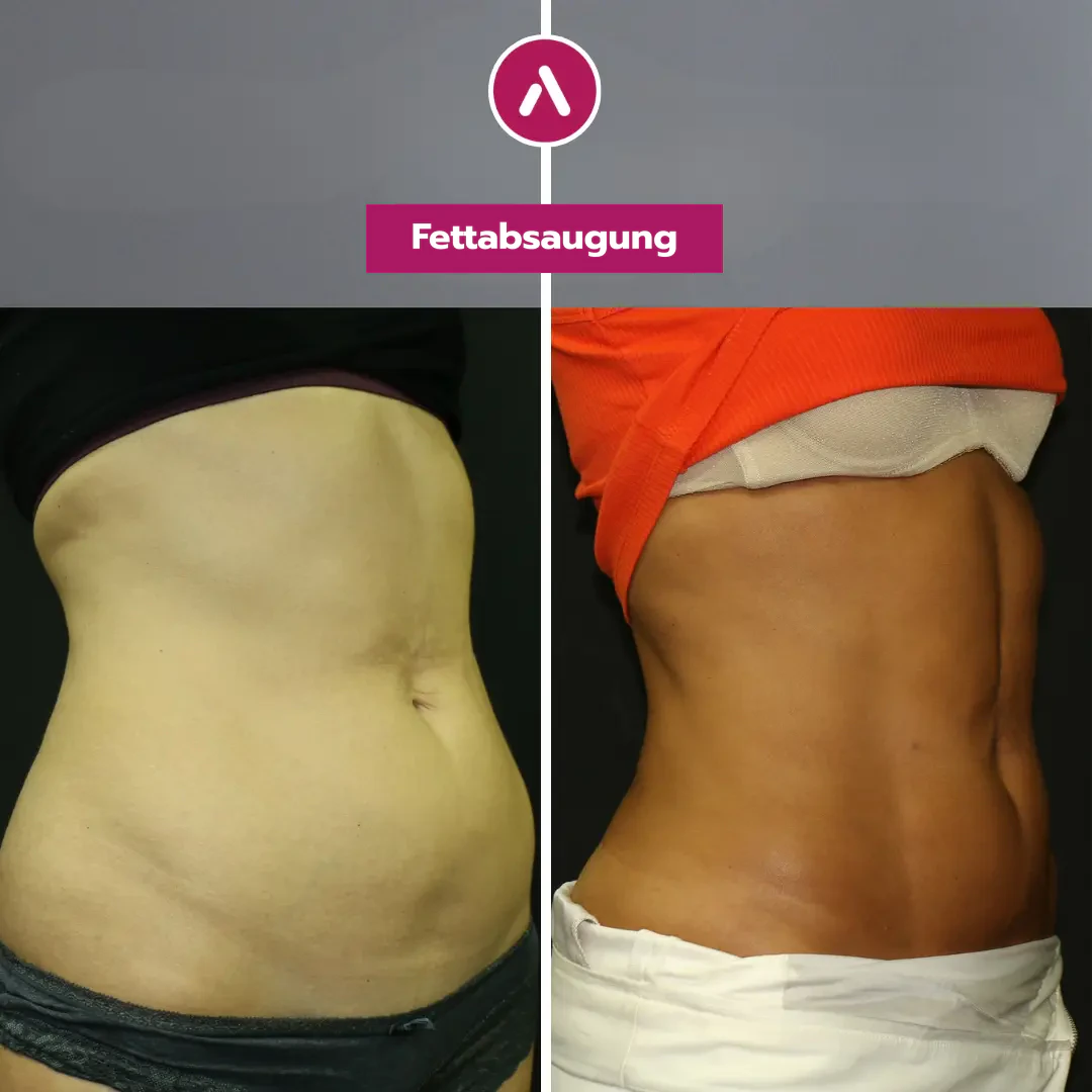 Schräg rechts vorher nachher: runder Bauch mit Hüftpolster (links), schmale Taille, flacher Bauch nach der Absaugung (rechts)