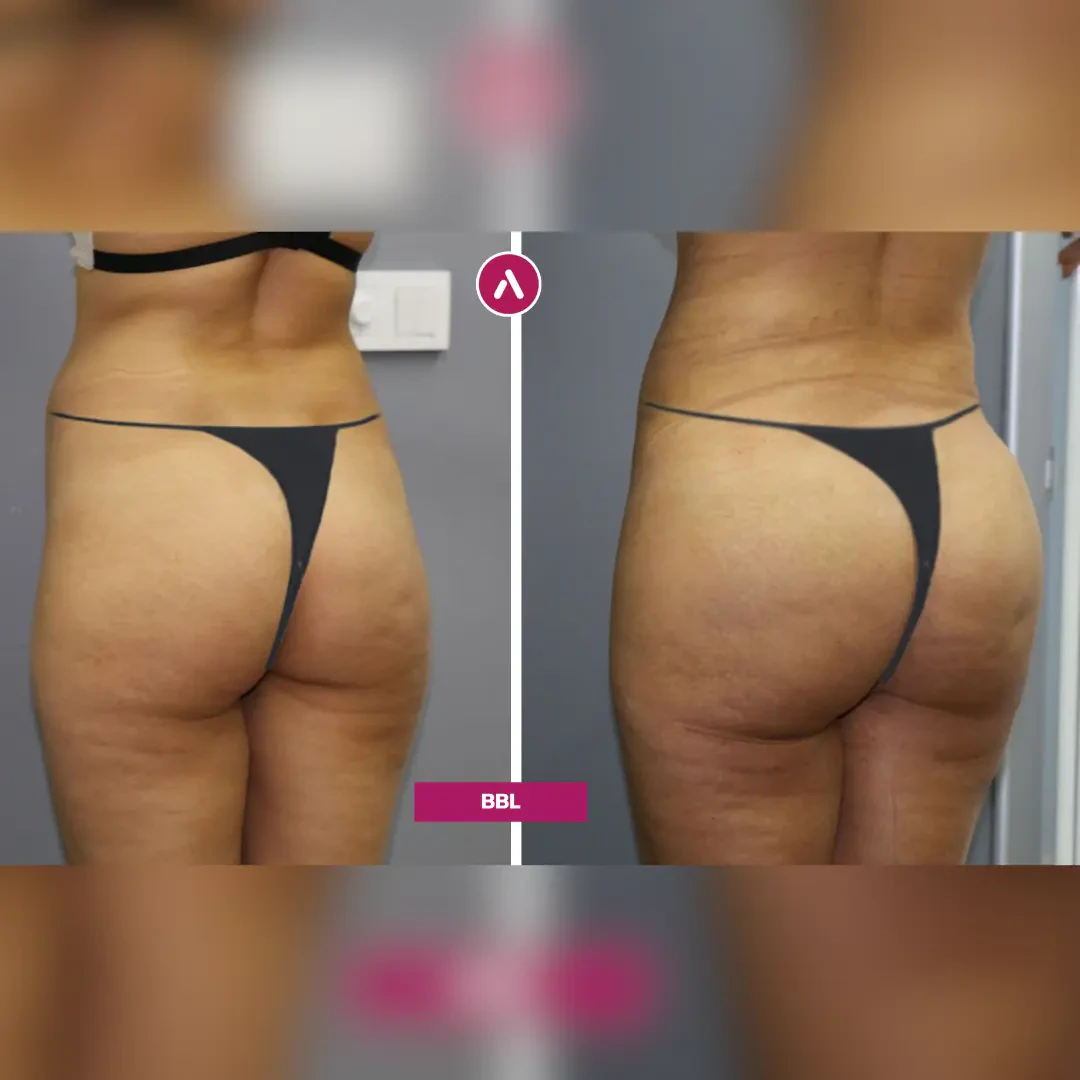 Lipo 360 + BBL vorher nachher, schräg von hinten links: flacheres Gesäß (links), rundere Kurve und schmalere Taille (rechts)